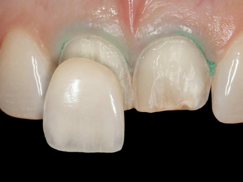 Nhược điểm của dán sứ Veneer