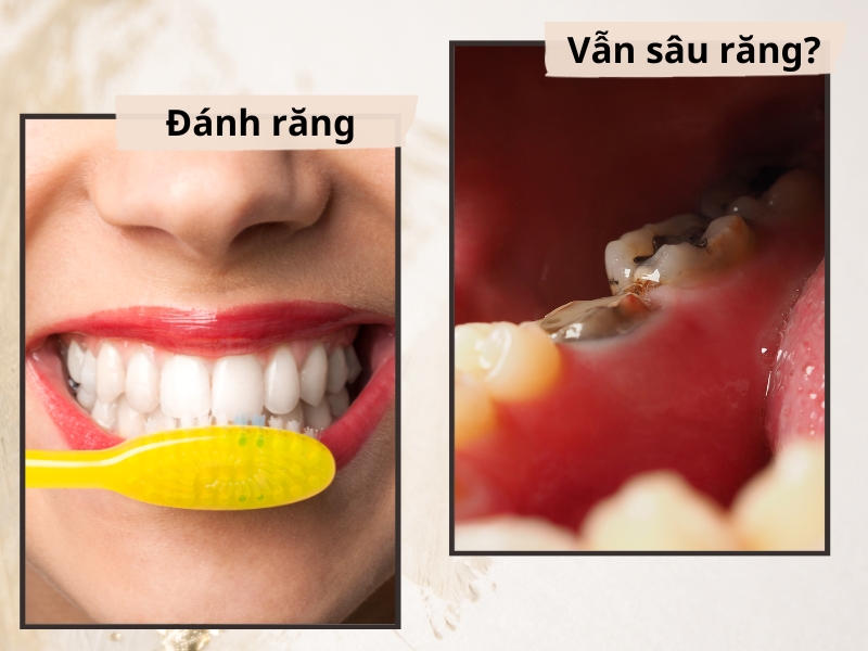 Vì sao đánh răng vẫn bị sâu răng