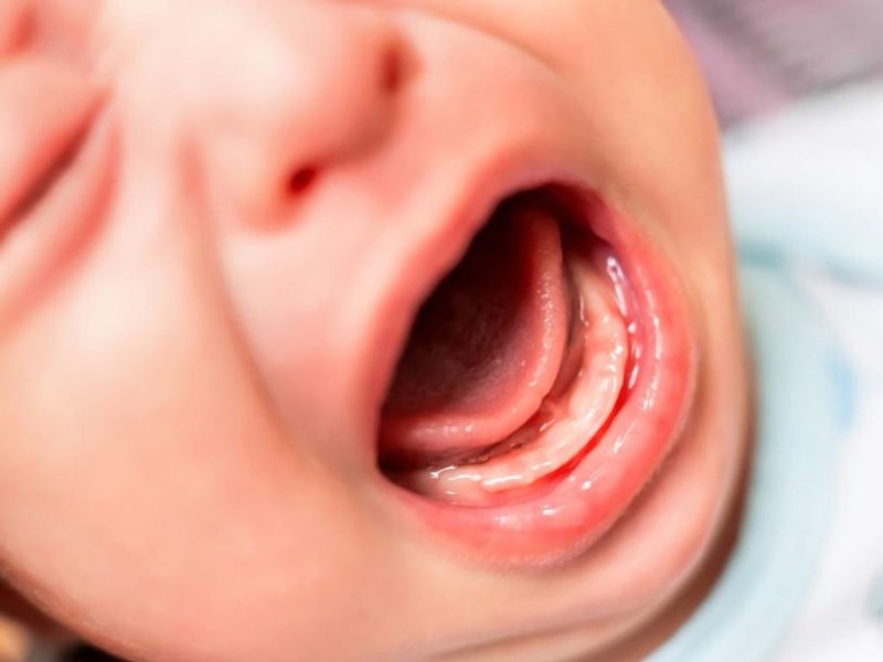 Dấu hiệu trẻ sốt mọc răng thường đi kèm với trẻ ngứa lợi, khó chịu, quấy khóc