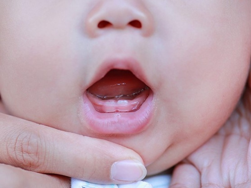 Dấu hiệu trẻ sốt mọc răng thường chỉ 1 - 3 ngày là tự hết