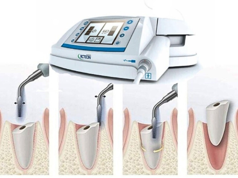 Nhổ răng khôn bằng sóng siêu âm nhanh chóng và hạn chế đau nhức