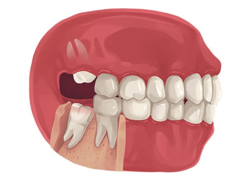 Răng khôn mọc phức tạp cần tiến hành cắt lợi, chia xương vì vậy cũng sẽ ảnh hưởng gây sưng mặt