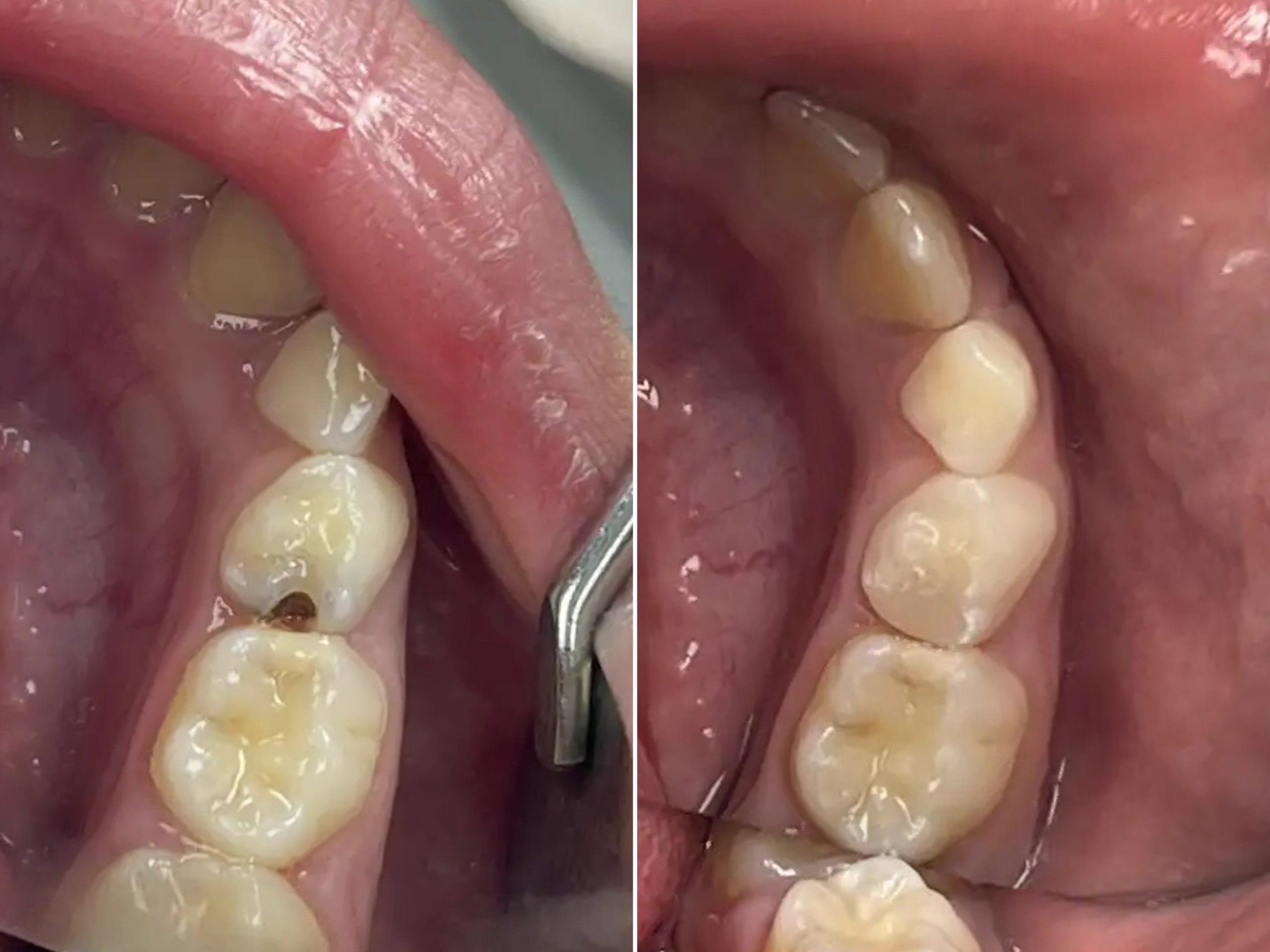 Trám răng mất bao nhiêu thời gian