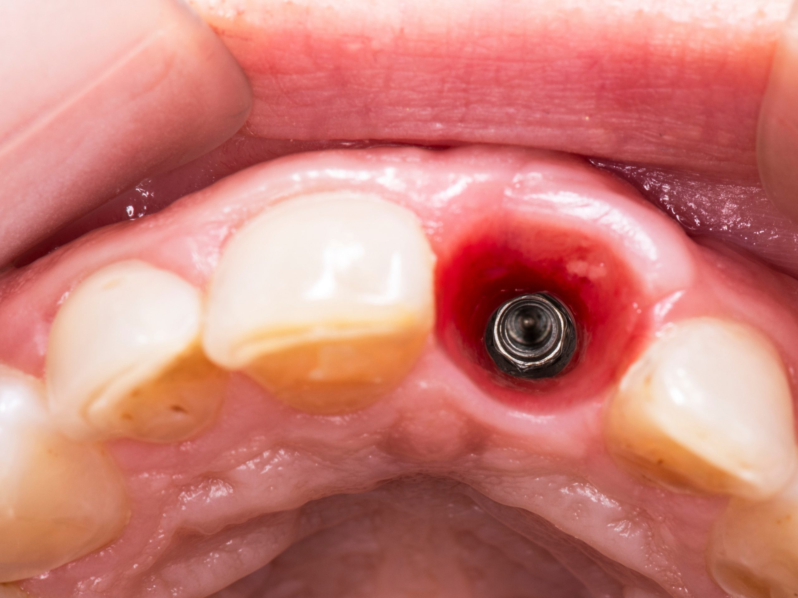 Trồng răng Implant ở đâu tốt
