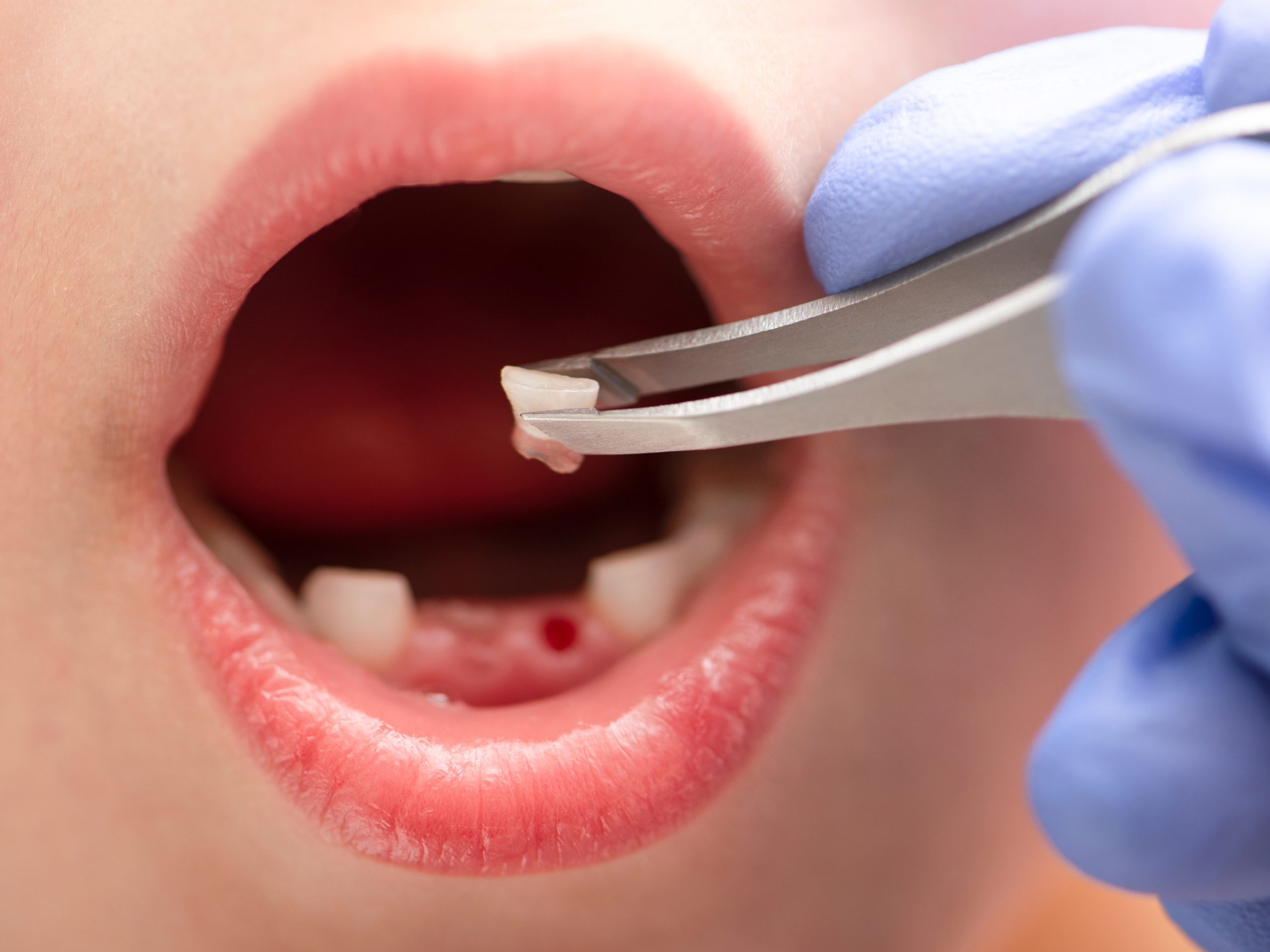 Nhổ răng sữa cho bé nhẹ nhàng và an toàn 