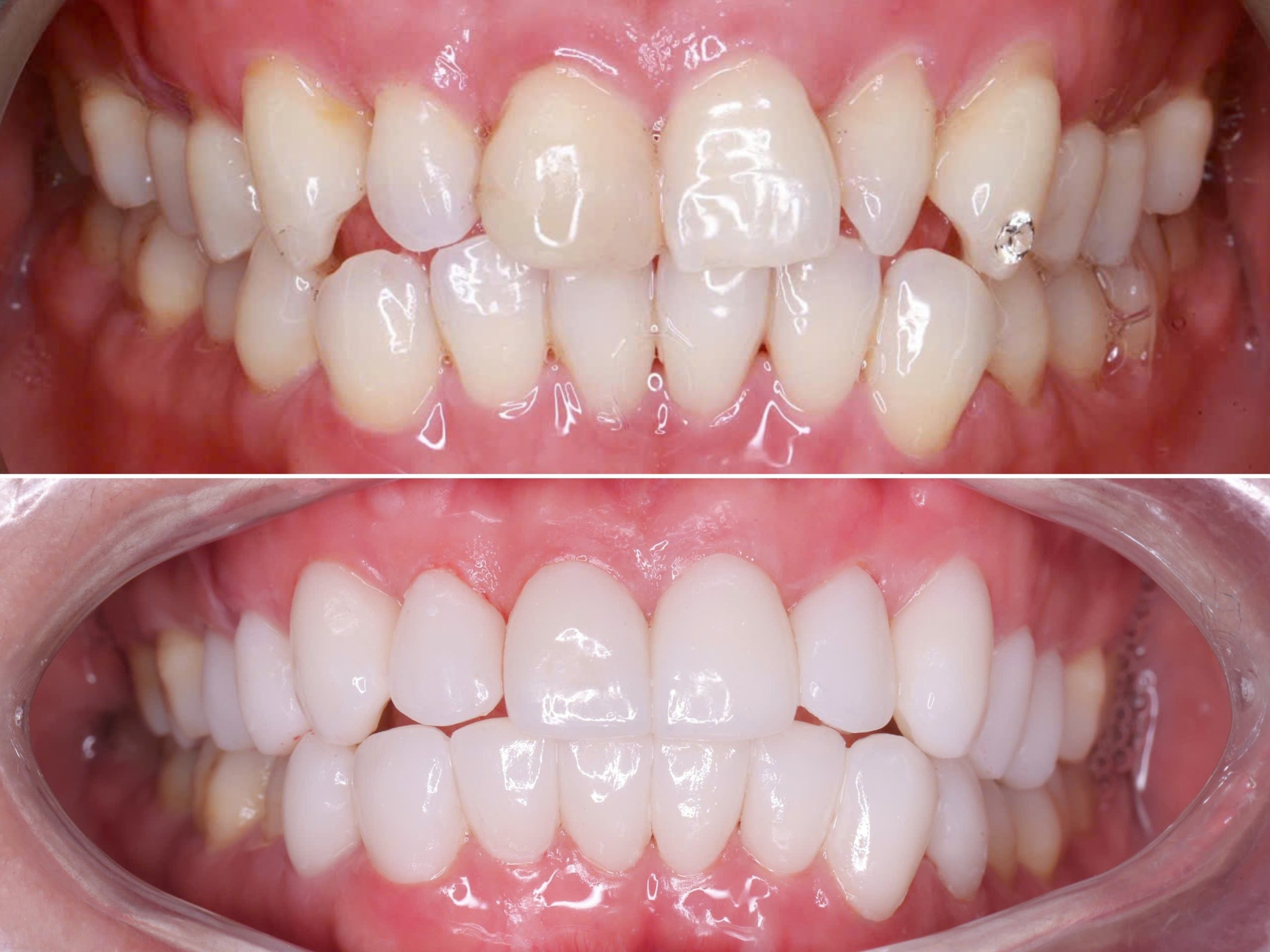 Dán sứ Veneer ở đâu uy tín tại Thái Nguyên