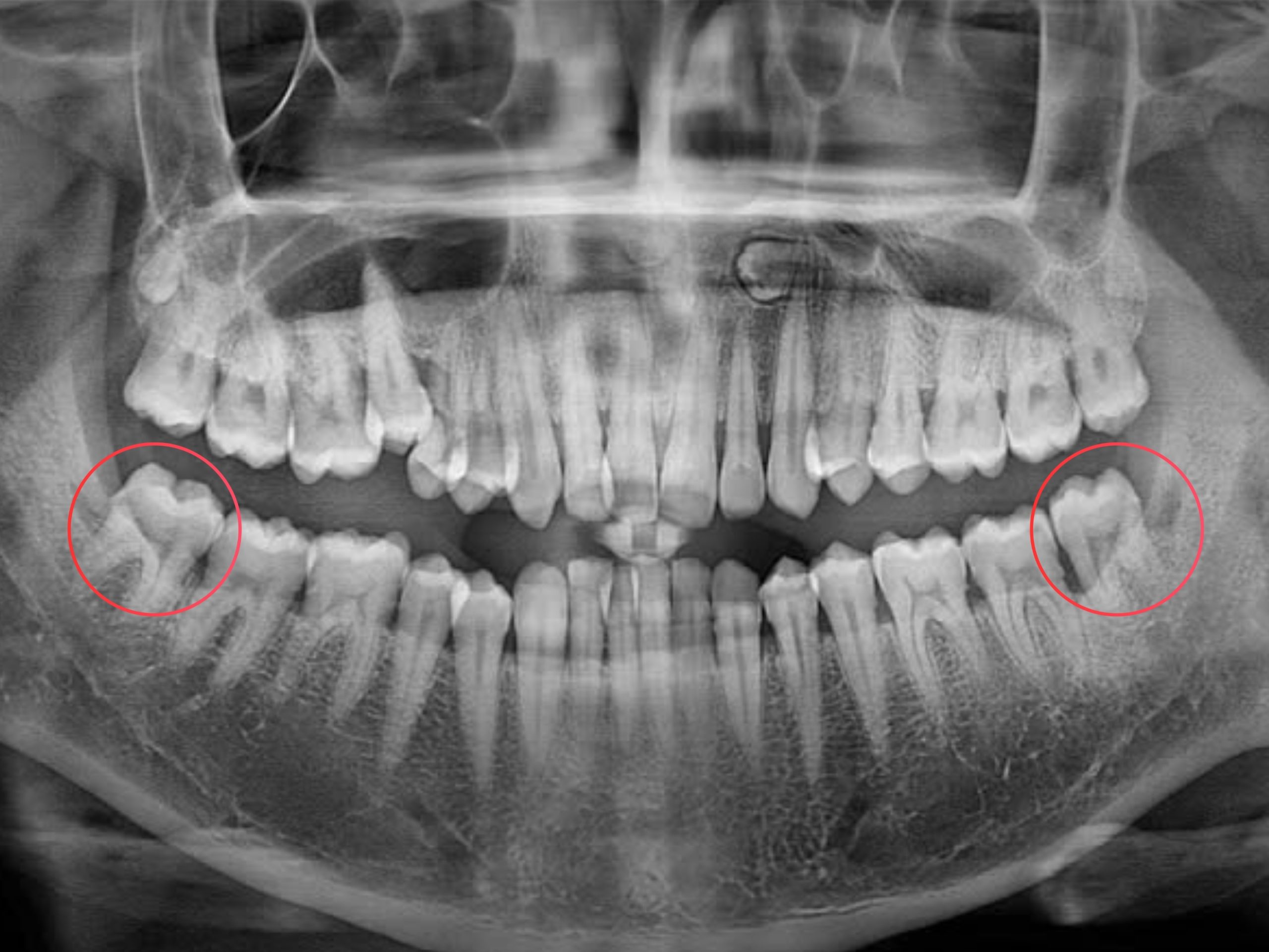 Răng khôn mọc thẳng có cần nhổ không là thắc mắc của nhiều người