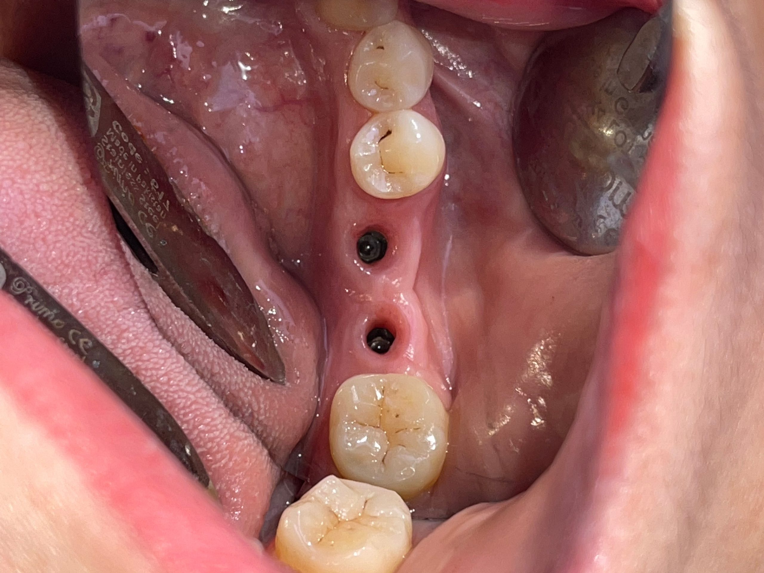 Quy trình cấy ghép Implant 