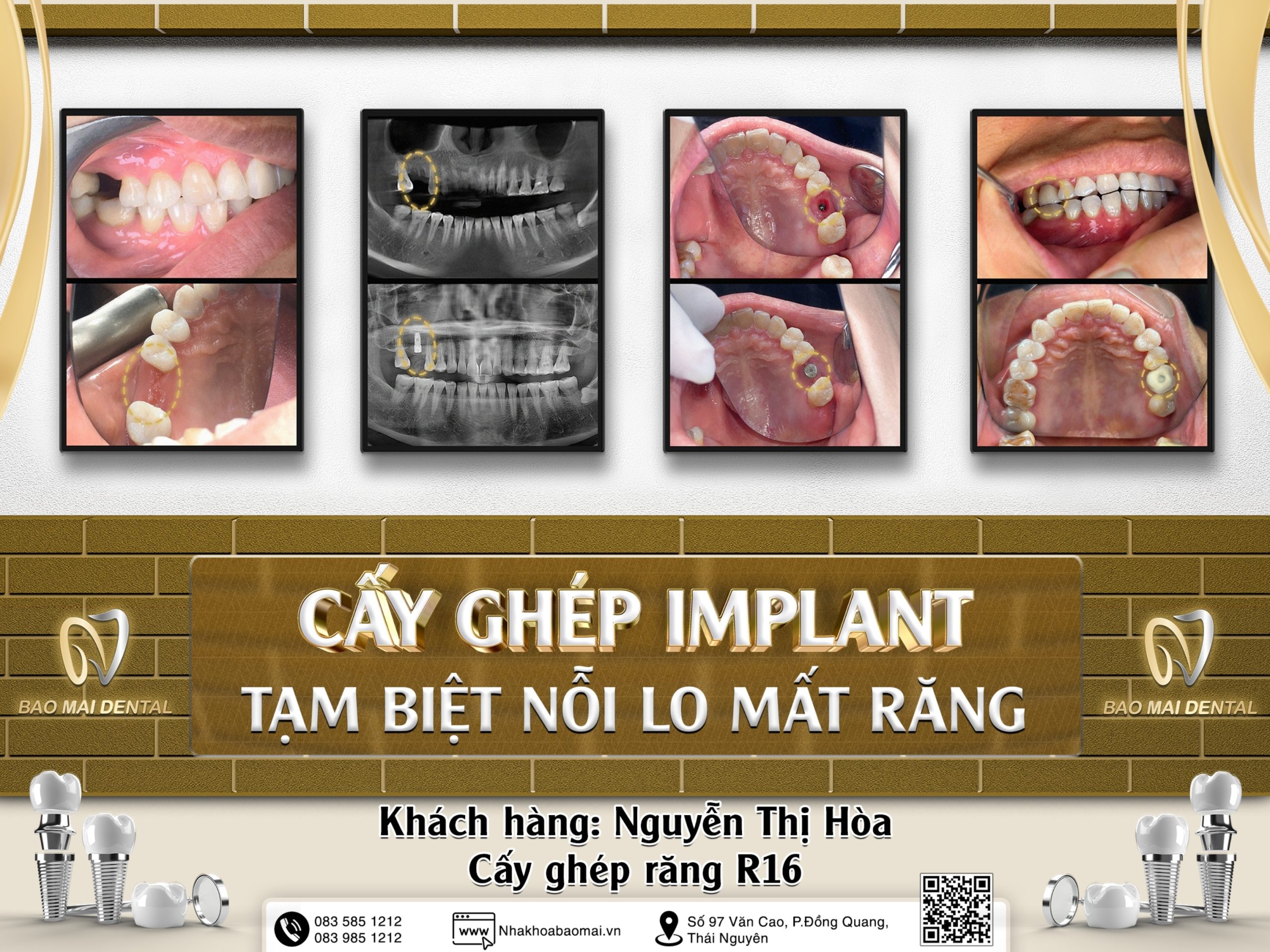 Quy trình cấy ghép Implant từ A - Z