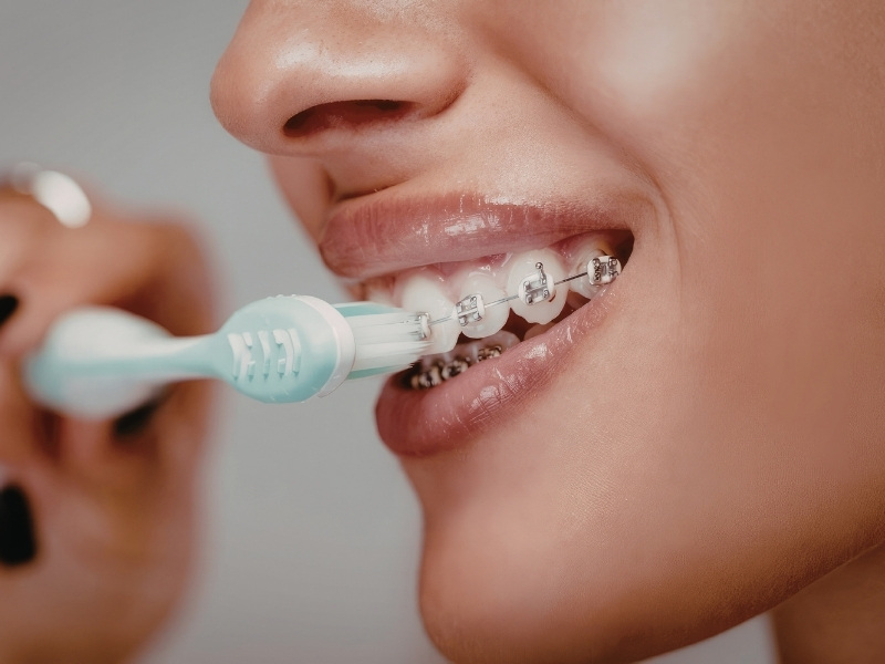 Bàn chải cho người niềng răng