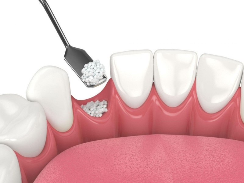 Ghép xương trong cấy ghép Implant là cần thiết cho trường hợp đã tiêu xương nhiều