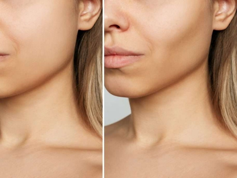 Niềng răng bị hóp má