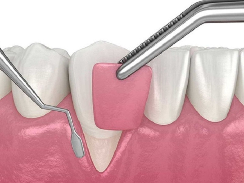 Cách điều trị niềng răng bị tụt lợi 