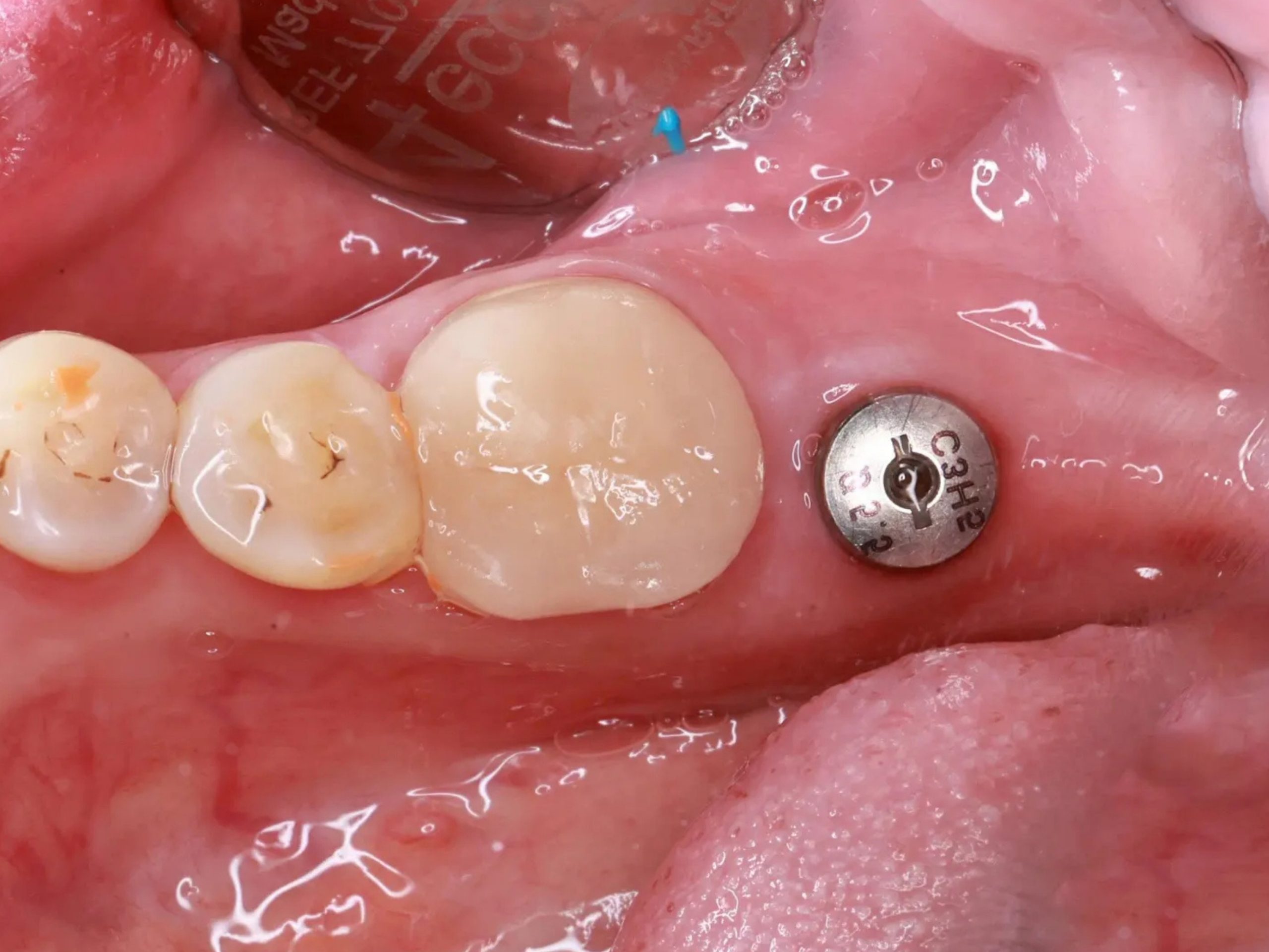 trồng răng Implant bao lâu thì ăn được