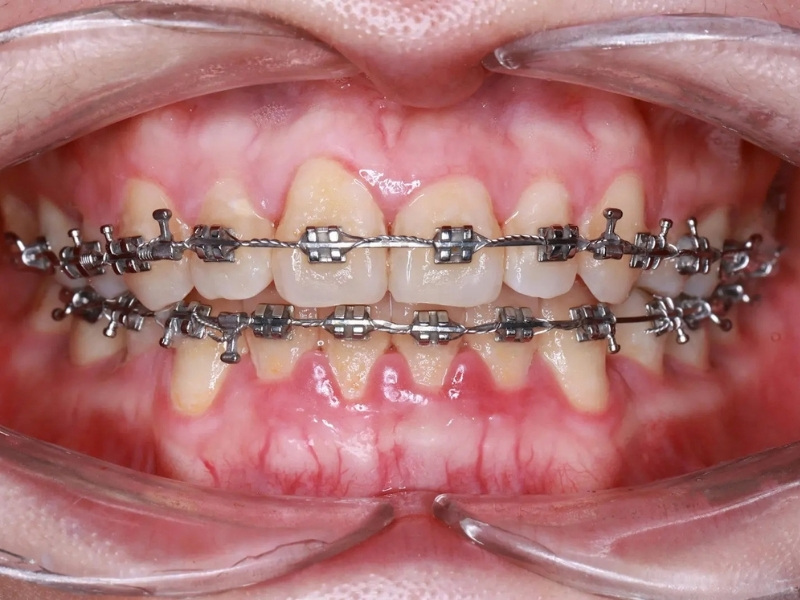 Niềng răng bị tụt lợi là tình trạng khá thường gặp