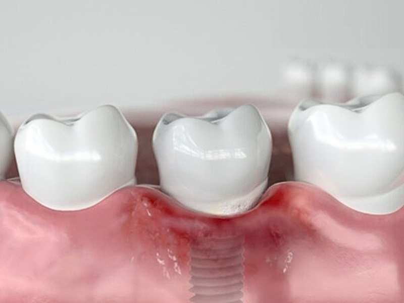 Biến chứng khi trồng Implant