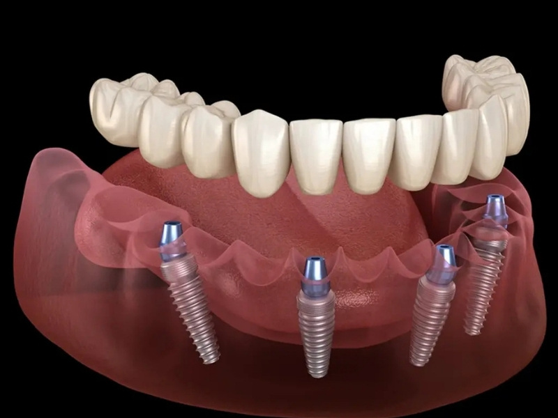 Trồng răng Implant all on 4 là gì 