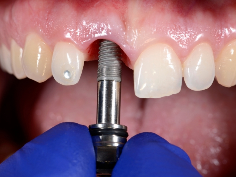 Trồng răng Implant có đau không 