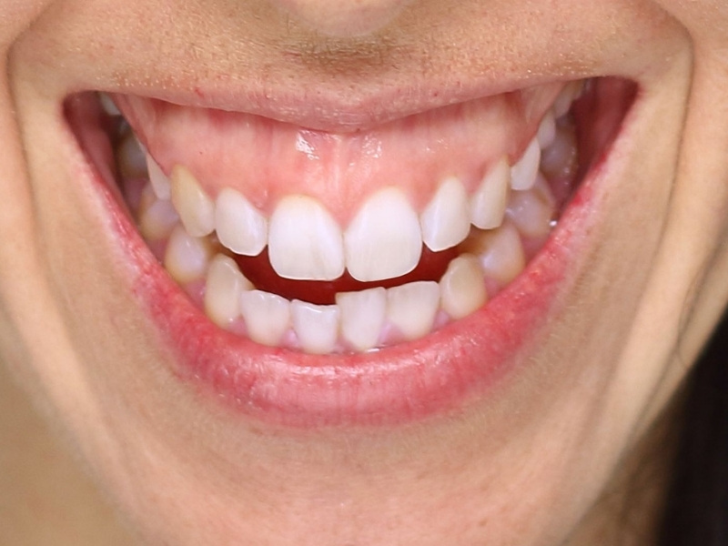 Cười hở lợi do đâu