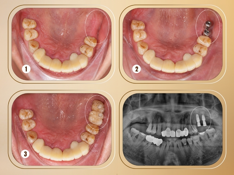 trồng răng Implant là gì