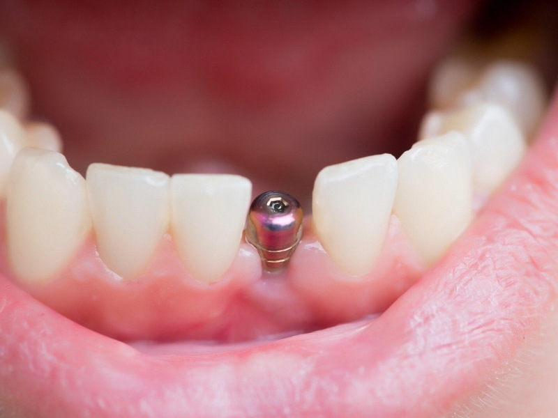 Trồng răng Implant là gì