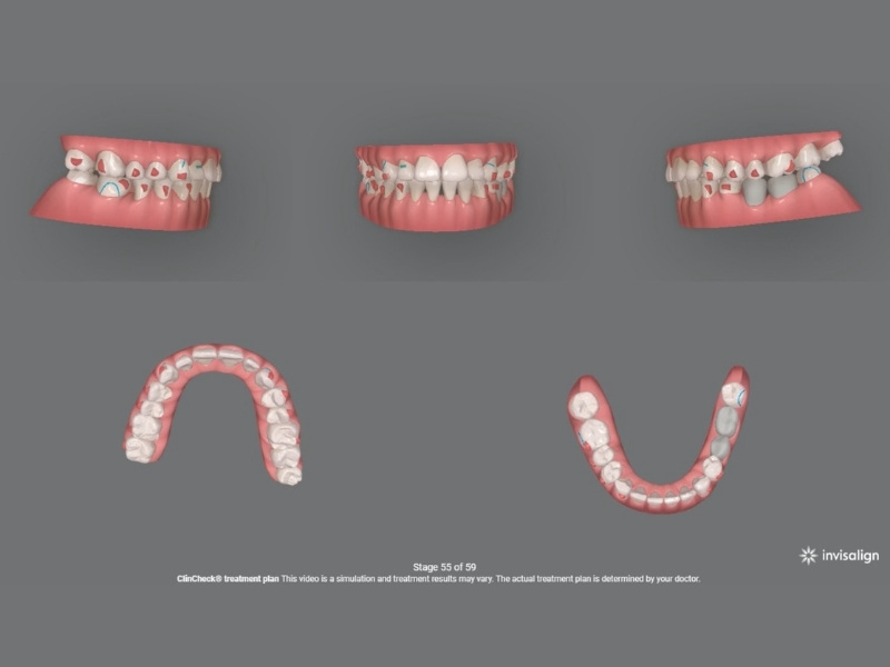 niềng răng invisalign là gì