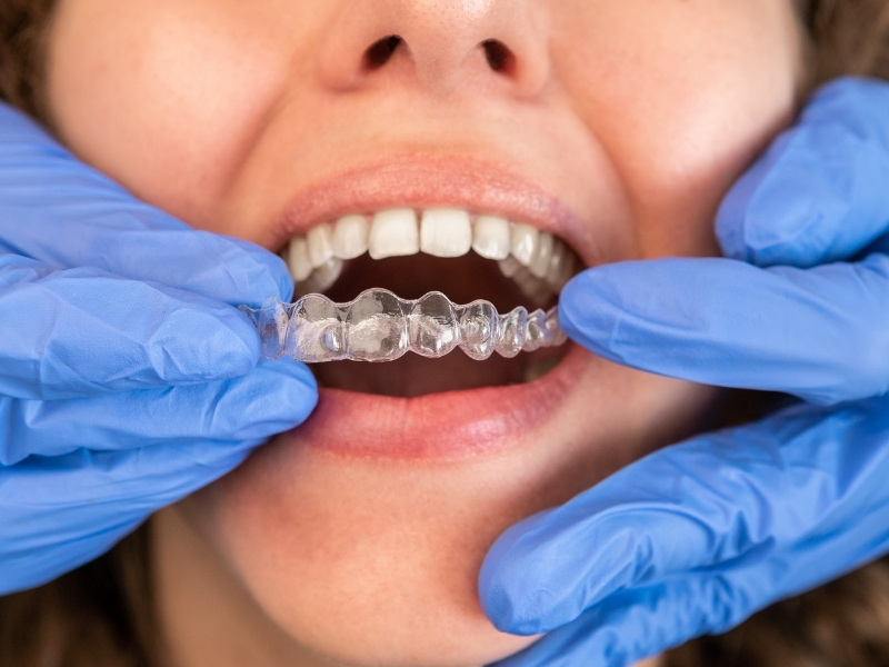 niềng răng Invisalign là gì