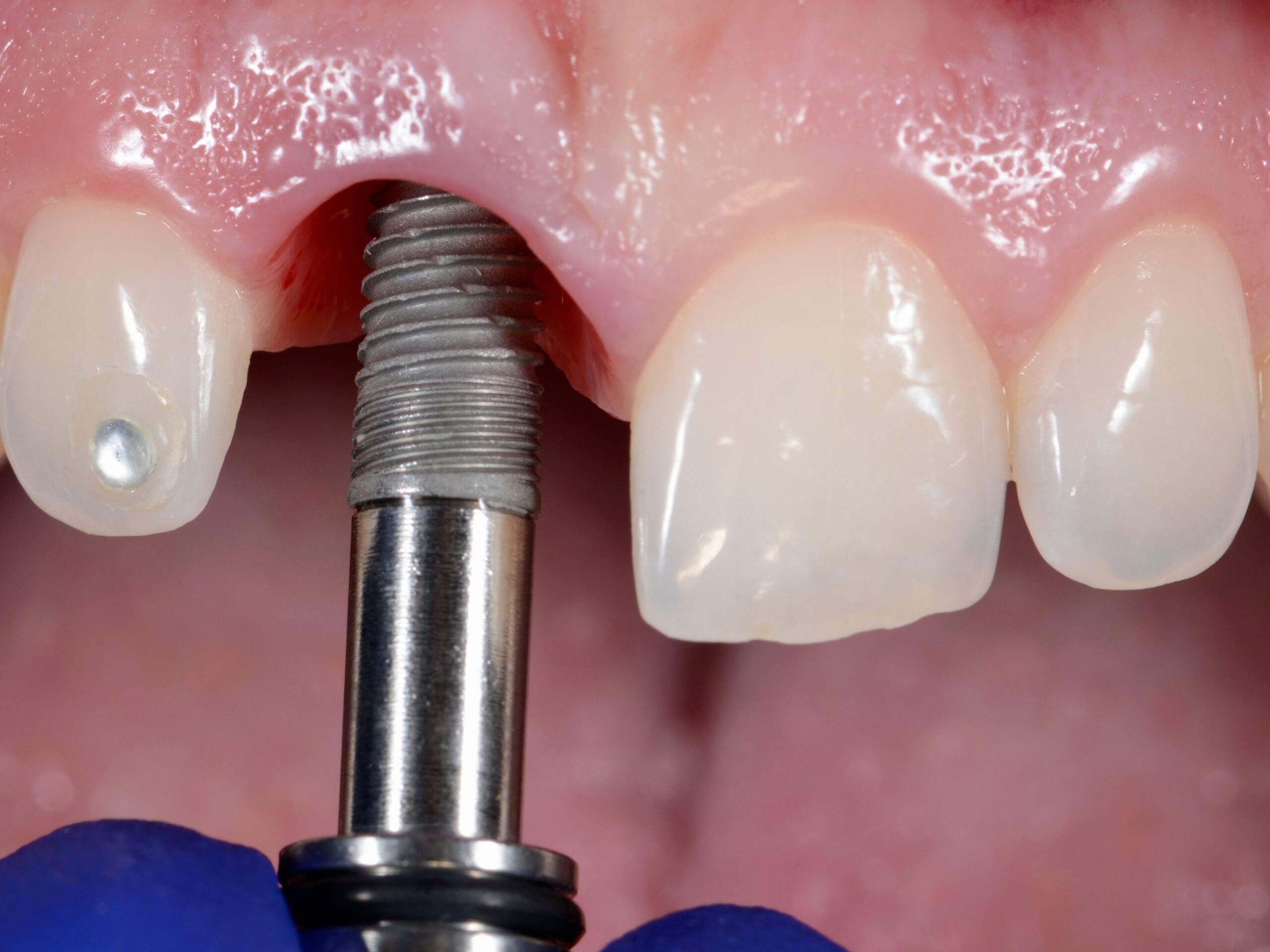 Trồng răng Implant cần lưu ý gì