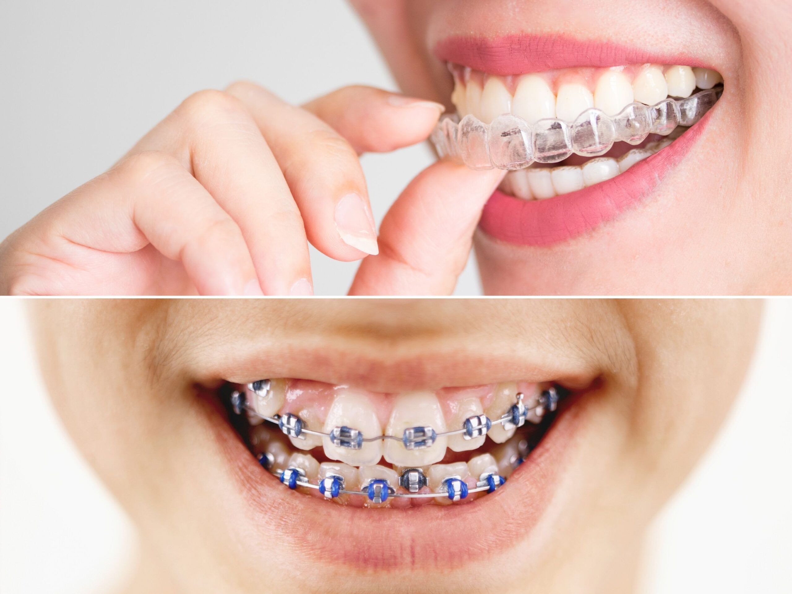 Bao nhiêu tuổi nên niềng răng?